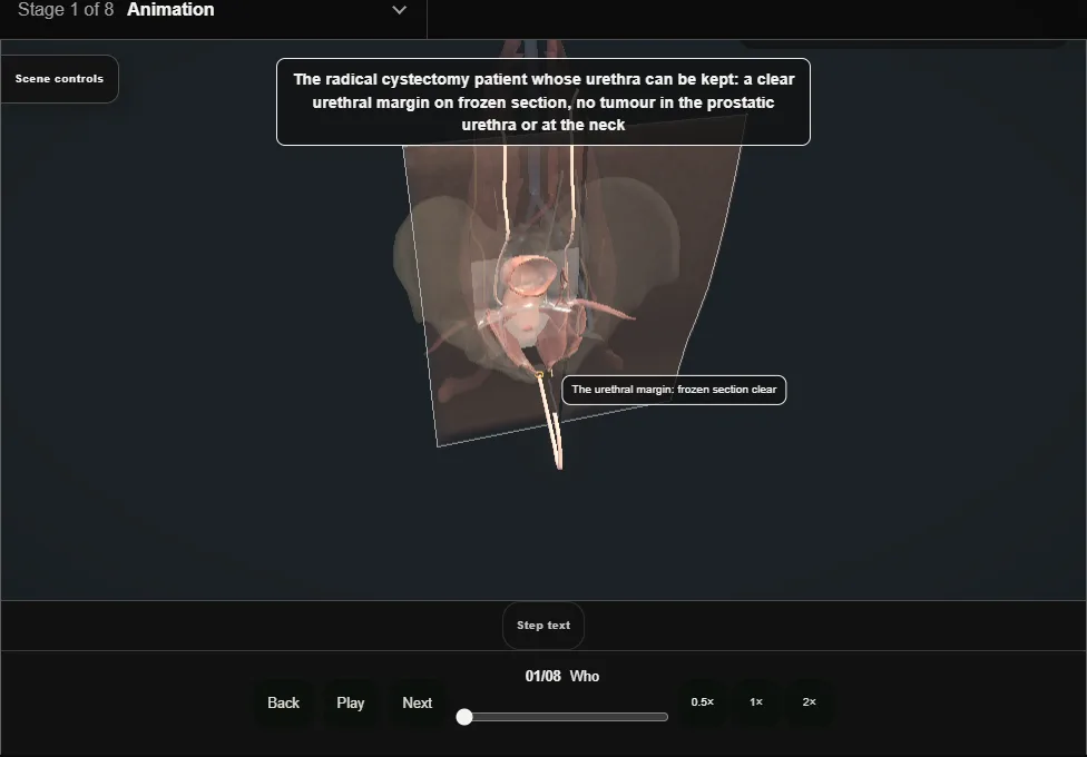 Orthotopic neobladder. Step 1: Who. Captured frame from the interactive animation.