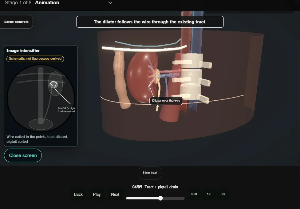 Percutaneous nephrostomy. Step 4: Tract + pigtail drain. Captured frame from the interactive animation.