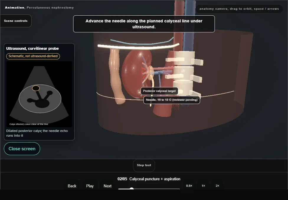 Percutaneous nephrostomy. Step 2: Calyceal puncture + aspiration. Captured frame from the interactive animation.
