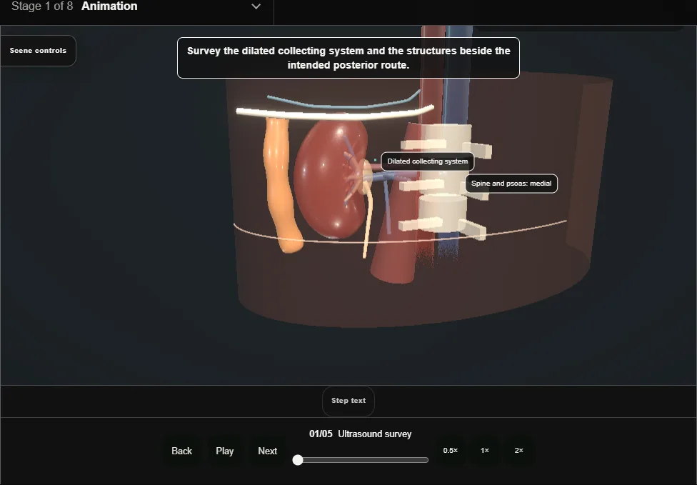 Percutaneous nephrostomy. Step 1: Ultrasound survey. Captured frame from the interactive animation.