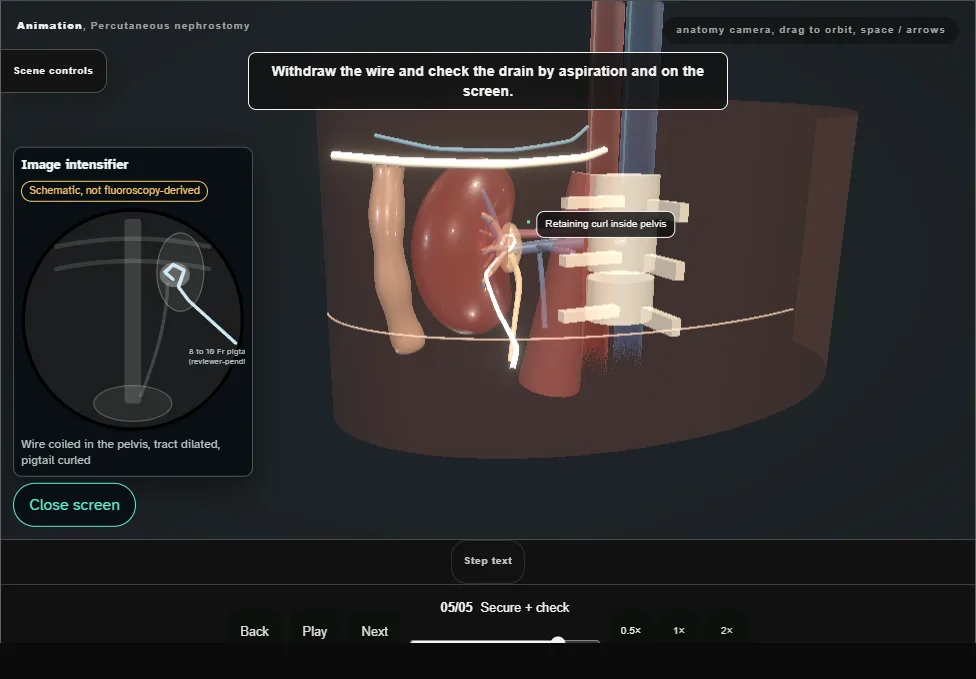 Percutaneous nephrostomy. Step 5: Secure + check. Captured frame from the interactive animation.