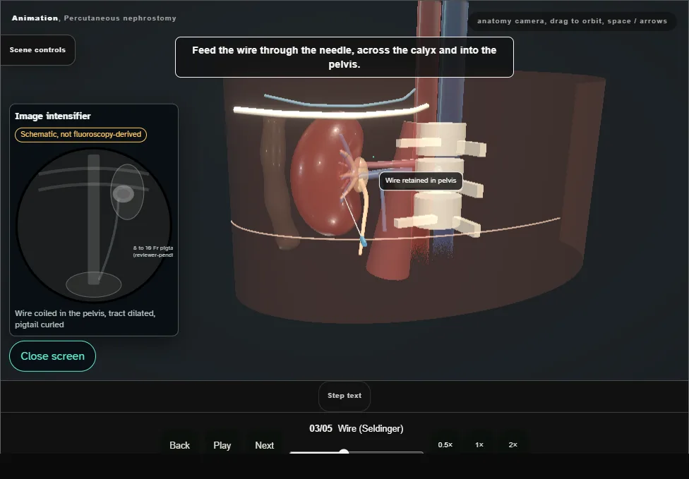 Percutaneous nephrostomy. Step 3: Wire (Seldinger). Captured frame from the interactive animation.