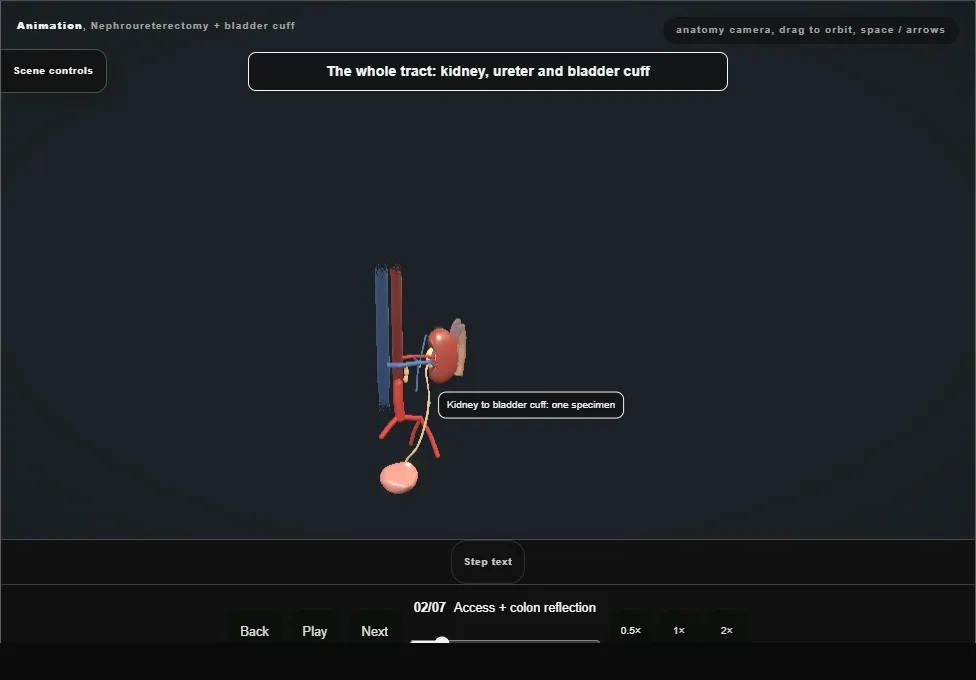 Nephroureterectomy + bladder cuff. Step 2: Access + colon reflection. Captured frame from the interactive animation.