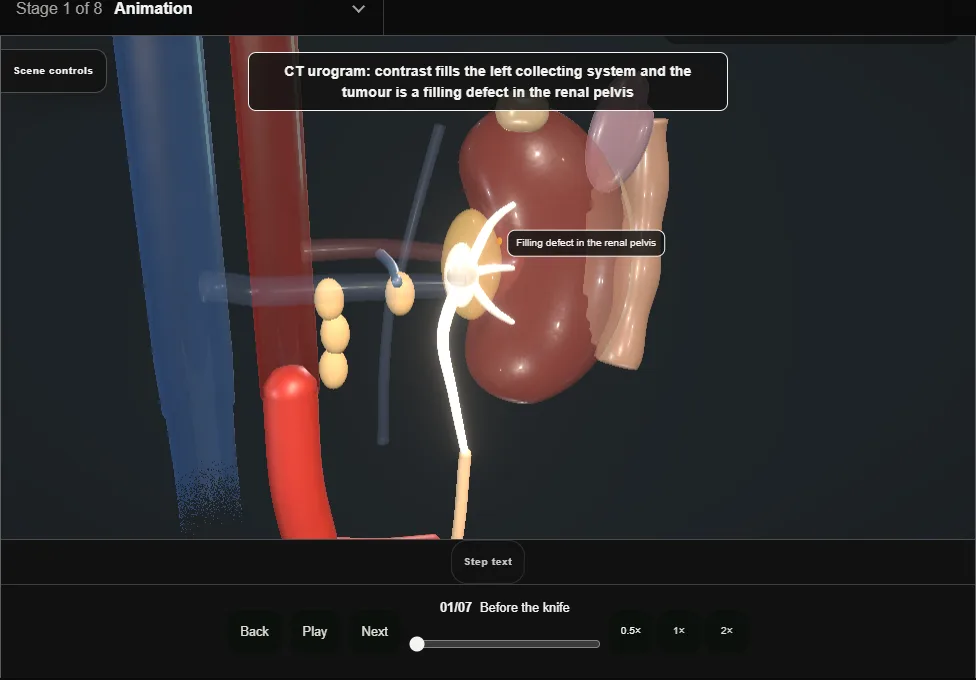 Nephroureterectomy + bladder cuff. Step 1: Before the knife. Captured frame from the interactive animation.