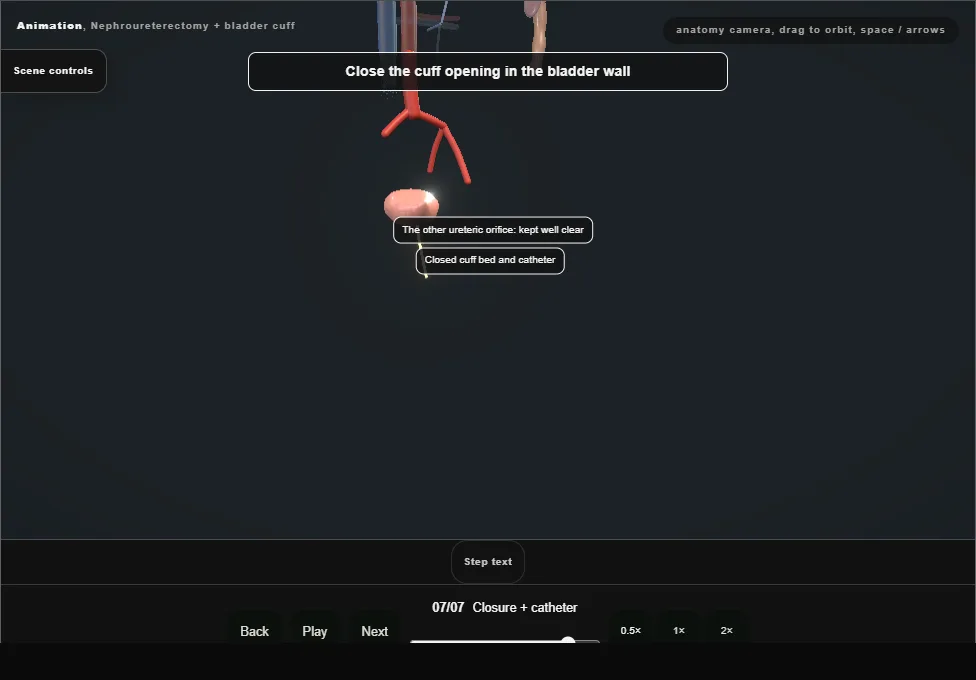 Nephroureterectomy + bladder cuff. Step 7: Closure + catheter. Captured frame from the interactive animation.