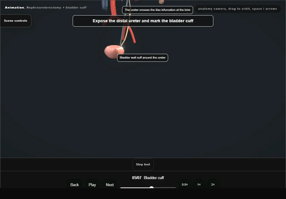 Nephroureterectomy + bladder cuff. Step 5: Bladder cuff. Captured frame from the interactive animation.