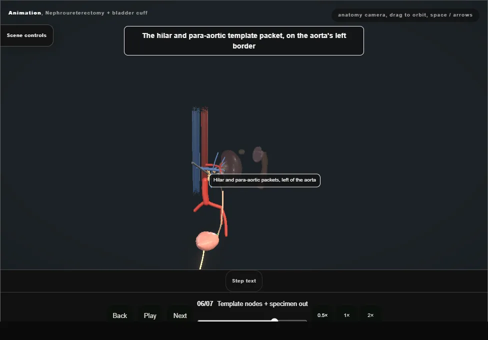 Nephroureterectomy + bladder cuff. Step 6: Template nodes + specimen out. Captured frame from the interactive animation.