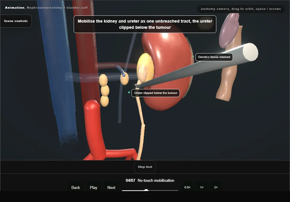Nephroureterectomy + bladder cuff. Step 4: No-touch mobilisation. Captured frame from the interactive animation.
