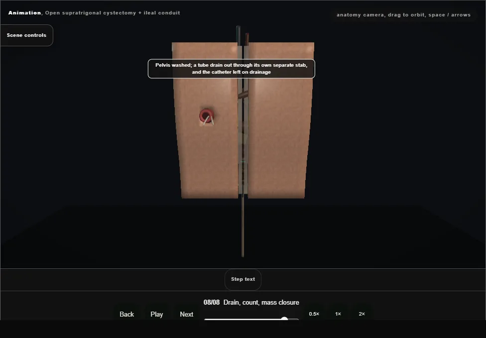Open supratrigonal cystectomy + ileal conduit. Step 8: Drain, count, mass closure. Captured frame from the interactive animation.
