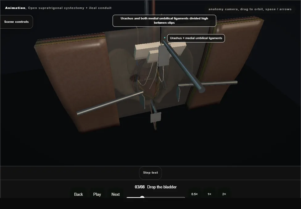 Open supratrigonal cystectomy + ileal conduit. Step 3: Drop the bladder. Captured frame from the interactive animation.