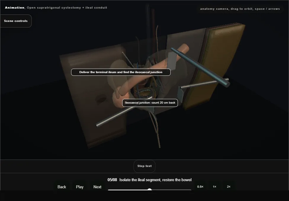 Open supratrigonal cystectomy + ileal conduit. Step 5: Isolate the ileal segment, restore the bowel. Captured frame from the interactive animation.