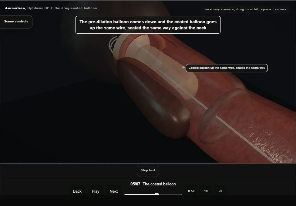 Optilume BPH: the drug-coated balloon. Step 5: The coated balloon. Captured frame from the interactive animation.