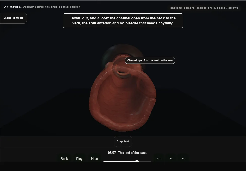 Optilume BPH: the drug-coated balloon. Step 6: The end of the case. Captured frame from the interactive animation.