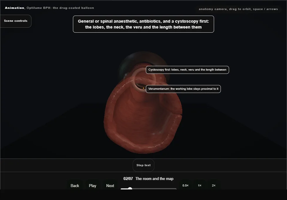 Optilume BPH: the drug-coated balloon. Step 2: The room and the map. Captured frame from the interactive animation.
