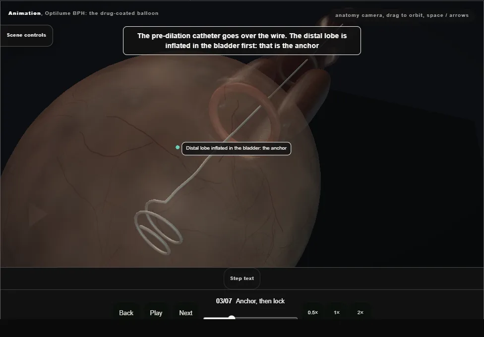 Optilume BPH: the drug-coated balloon. Step 3: Anchor, then lock. Captured frame from the interactive animation.