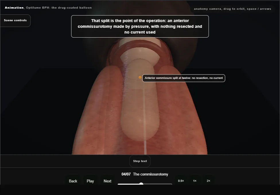 Optilume BPH: the drug-coated balloon. Step 4: The commissurotomy. Captured frame from the interactive animation.
