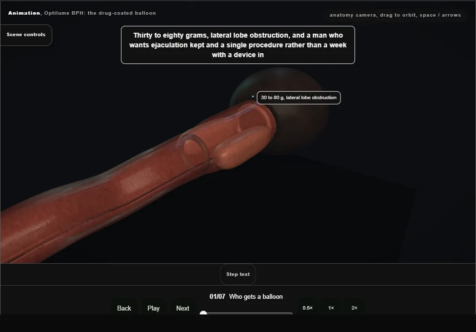 Optilume BPH: the drug-coated balloon. Step 1: Who gets a balloon. Captured frame from the interactive animation.