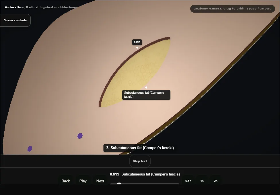 Radical inguinal orchidectomy. Step 3: Subcutaneous fat (Camper's fascia). Captured frame from the interactive animation.