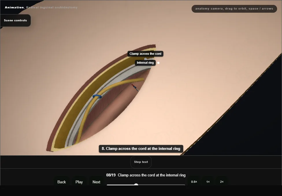 Radical inguinal orchidectomy. Step 8: Clamp across the cord at the internal ring. Captured frame from the interactive animation.