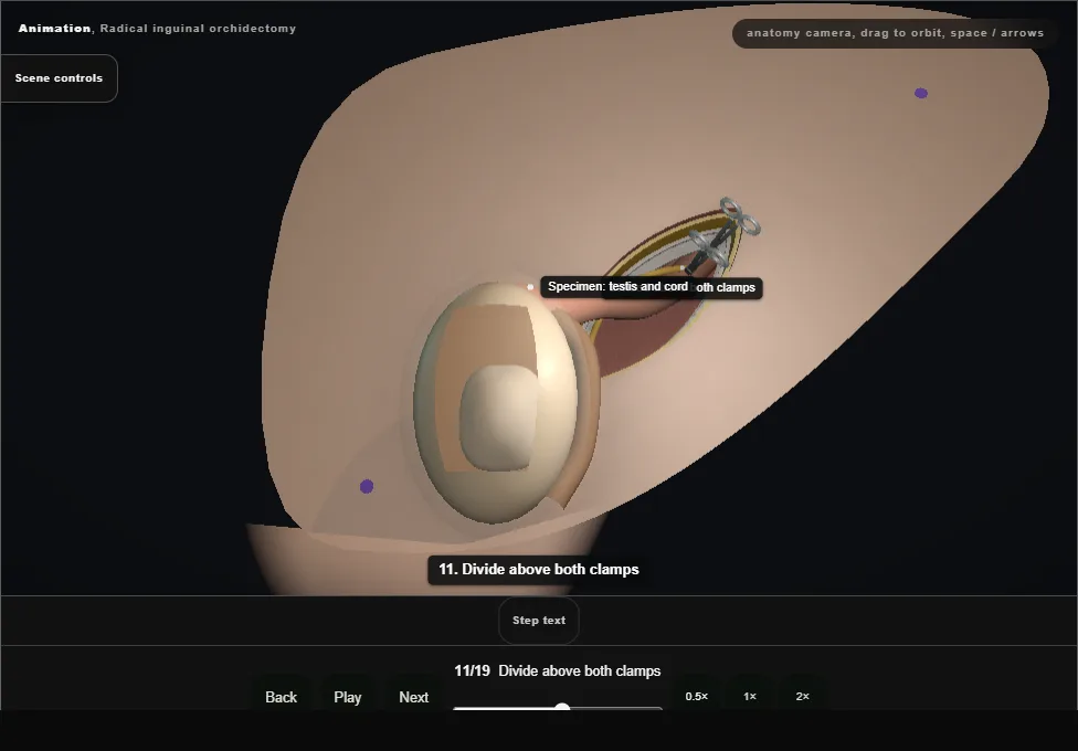 Radical inguinal orchidectomy. Step 11: Divide above both clamps. Captured frame from the interactive animation.