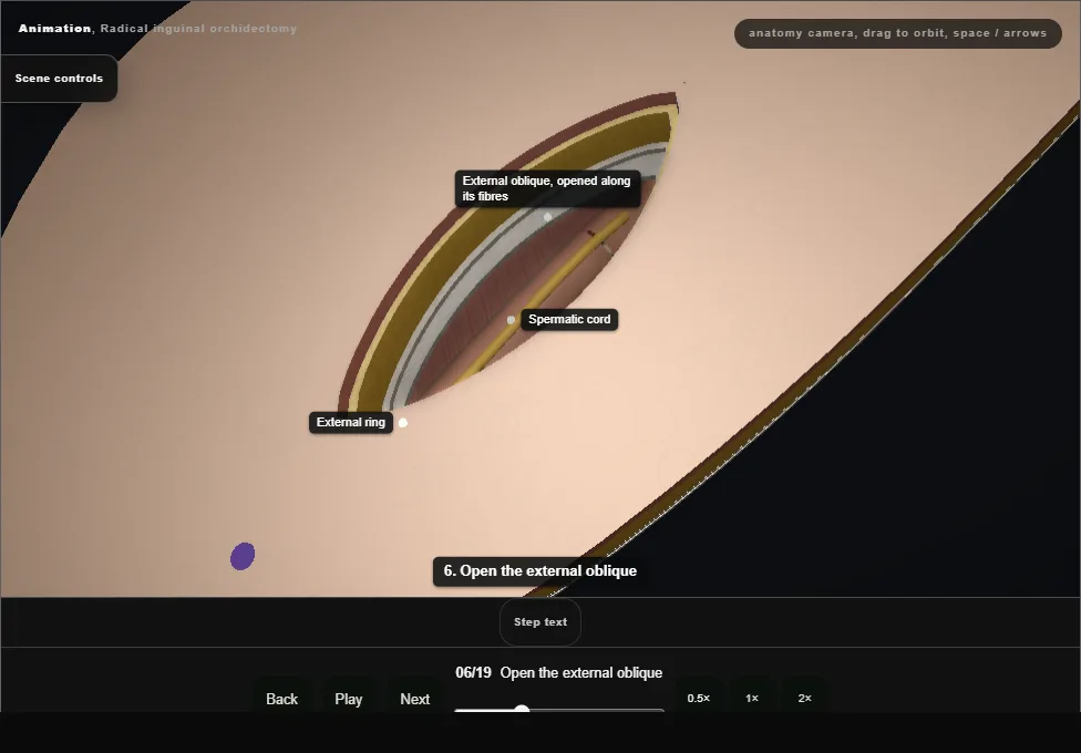 Radical inguinal orchidectomy. Step 6: Open the external oblique. Captured frame from the interactive animation.