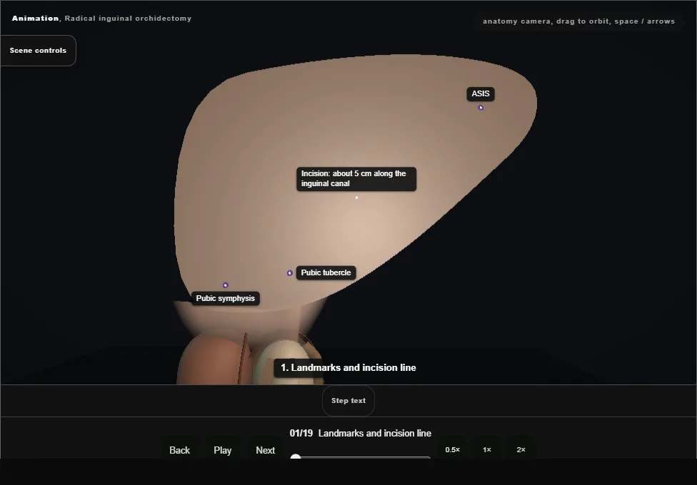 Radical inguinal orchidectomy. Step 1: Landmarks and incision line. Captured frame from the interactive animation.