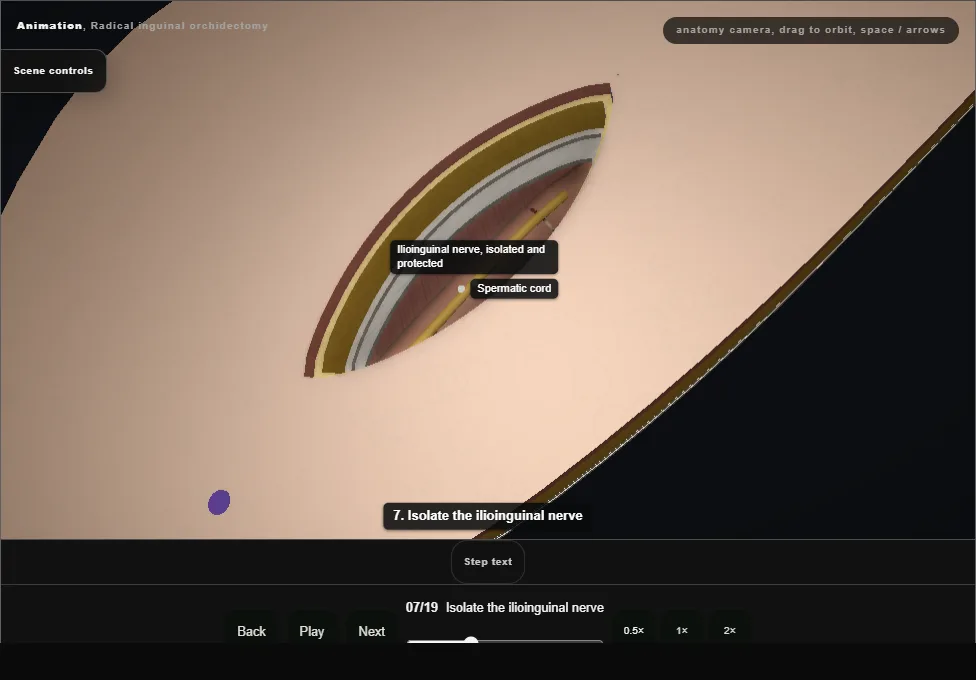Radical inguinal orchidectomy. Step 7: Isolate the ilioinguinal nerve. Captured frame from the interactive animation.