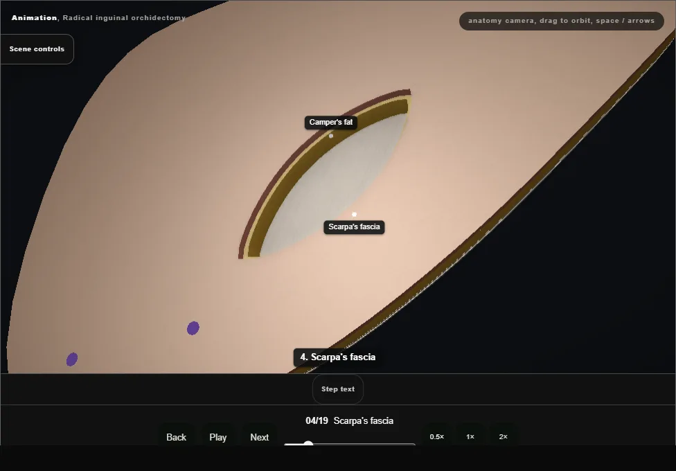 Radical inguinal orchidectomy. Step 4: Scarpa's fascia. Captured frame from the interactive animation.