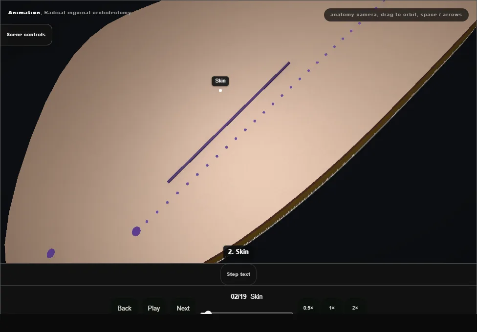 Radical inguinal orchidectomy. Step 2: Skin. Captured frame from the interactive animation.