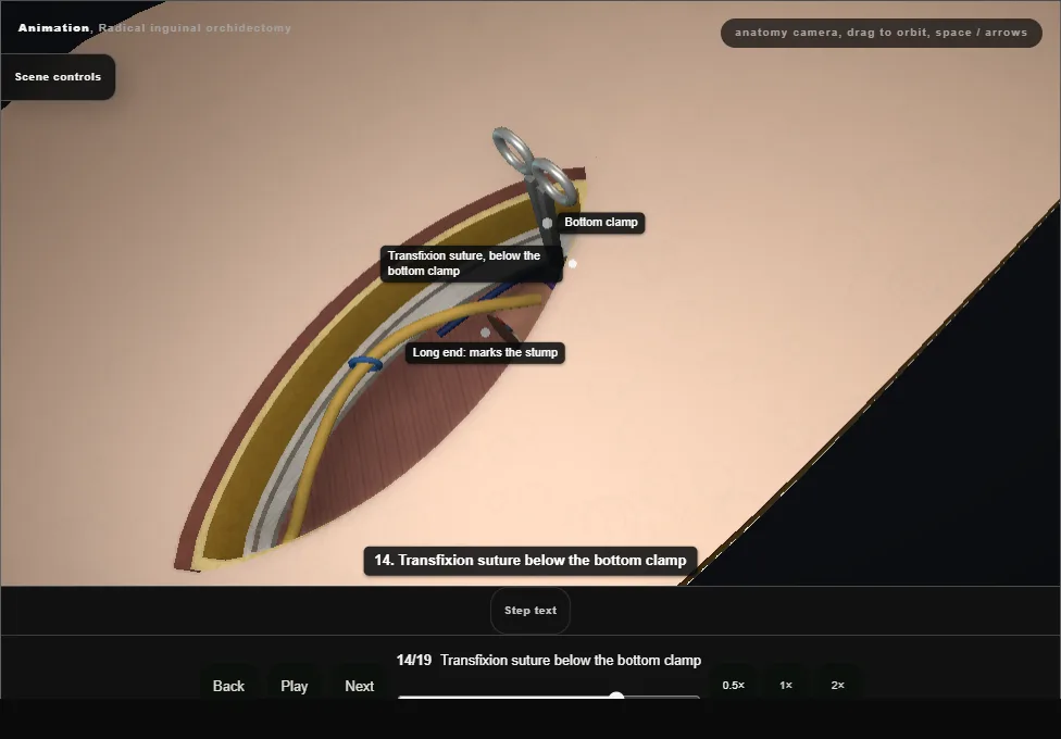 Radical inguinal orchidectomy. Step 14: Transfixion suture below the bottom clamp. Captured frame from the interactive animation.