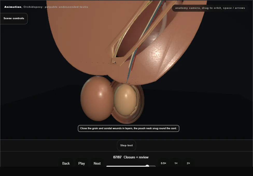 Orchidopexy: palpable undescended testis. Step 7: Closure + review. Captured frame from the interactive animation.