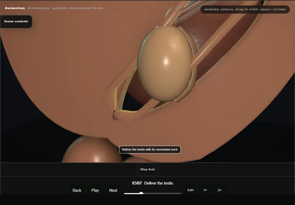 Orchidopexy: palpable undescended testis. Step 3: Deliver the testis. Captured frame from the interactive animation.