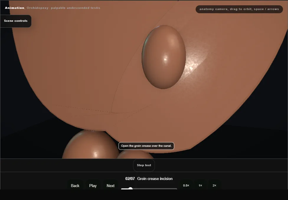 Orchidopexy: palpable undescended testis. Step 2: Groin crease incision. Captured frame from the interactive animation.