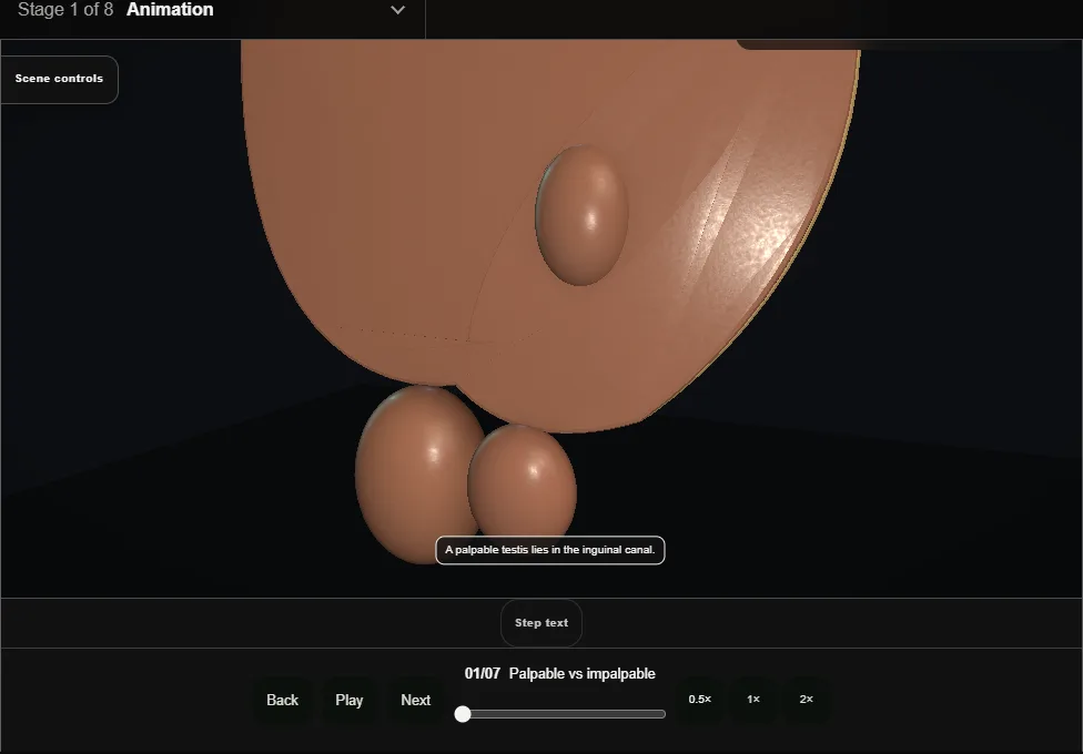 Orchidopexy: palpable undescended testis. Step 1: Palpable vs impalpable. Captured frame from the interactive animation.