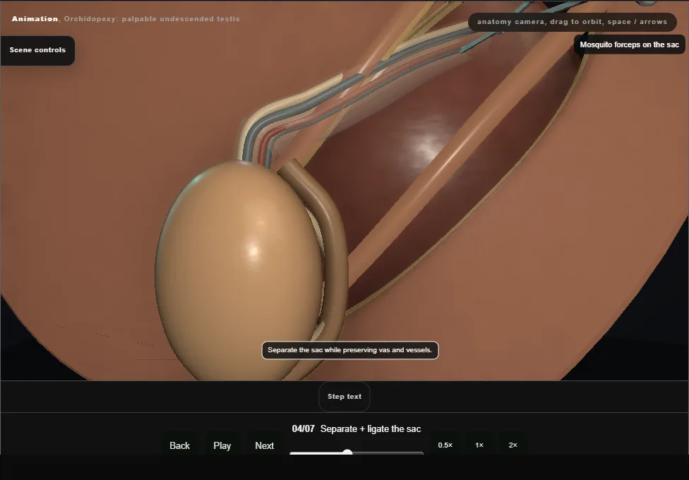 Orchidopexy: palpable undescended testis. Step 4: Separate + ligate the sac. Captured frame from the interactive animation.
