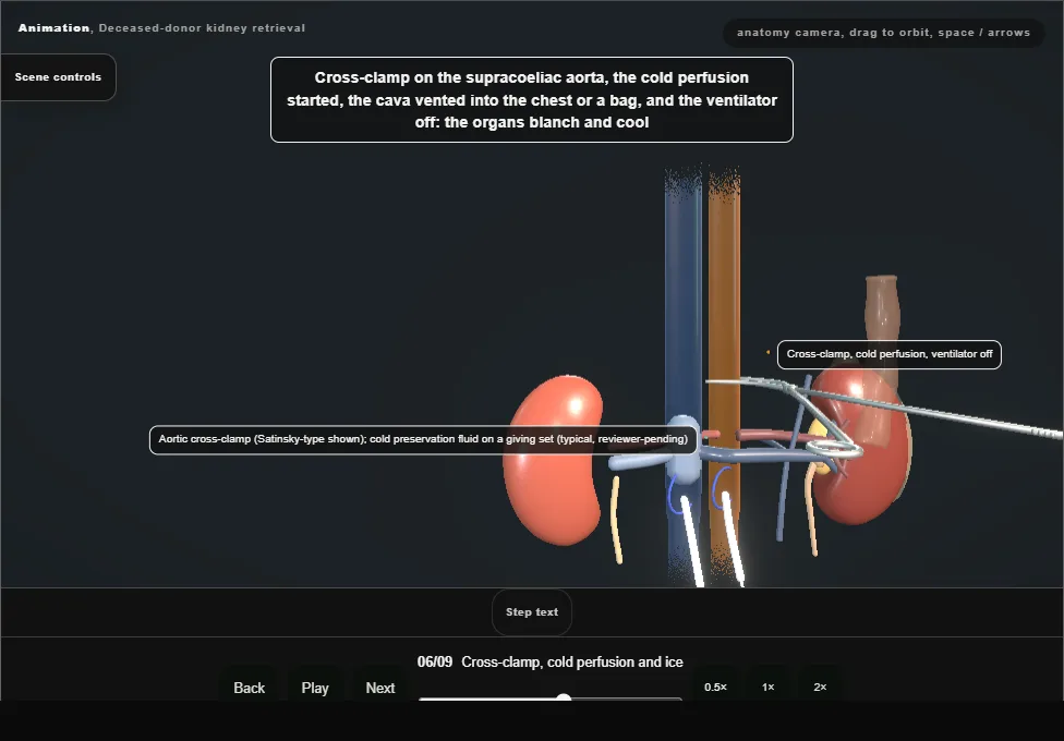 Deceased-donor kidney retrieval. Step 6: Cross-clamp, cold perfusion and ice. Captured frame from the interactive animation.