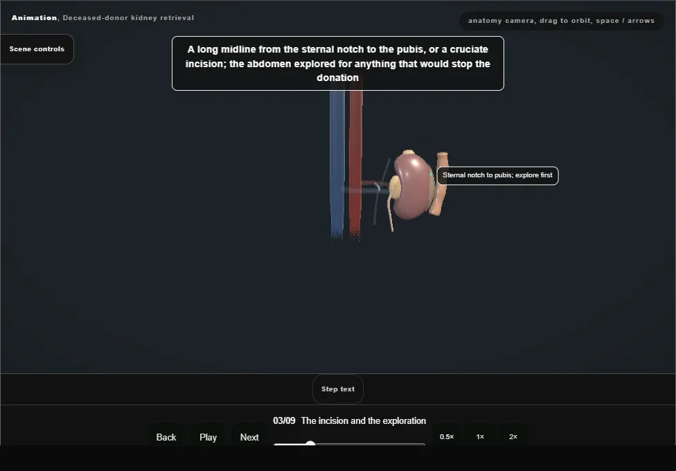 Deceased-donor kidney retrieval. Step 3: The incision and the exploration. Captured frame from the interactive animation.