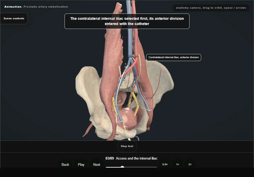 Prostatic artery embolisation. Step 3: Access and the internal iliac. Captured frame from the interactive animation.