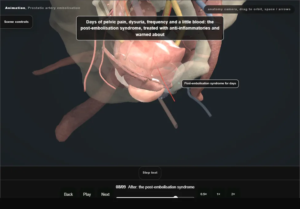 Prostatic artery embolisation. Step 8: After: the post-embolisation syndrome. Captured frame from the interactive animation.