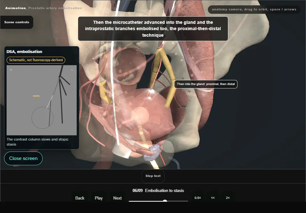 Prostatic artery embolisation. Step 6: Embolisation to stasis. Captured frame from the interactive animation.