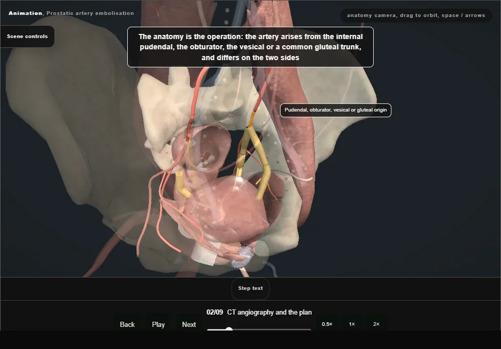 Prostatic artery embolisation. Step 2: CT angiography and the plan. Captured frame from the interactive animation.