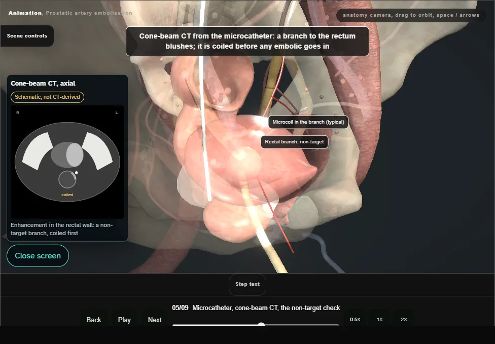 Prostatic artery embolisation. Step 5: Microcatheter, cone-beam CT, the non-target check. Captured frame from the interactive animation.
