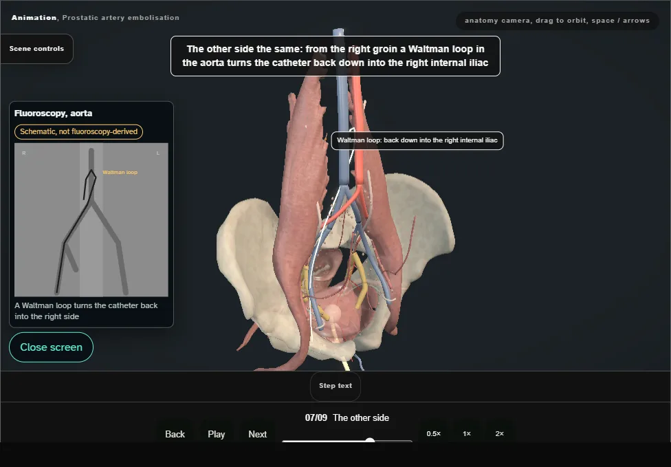 Prostatic artery embolisation. Step 7: The other side. Captured frame from the interactive animation.