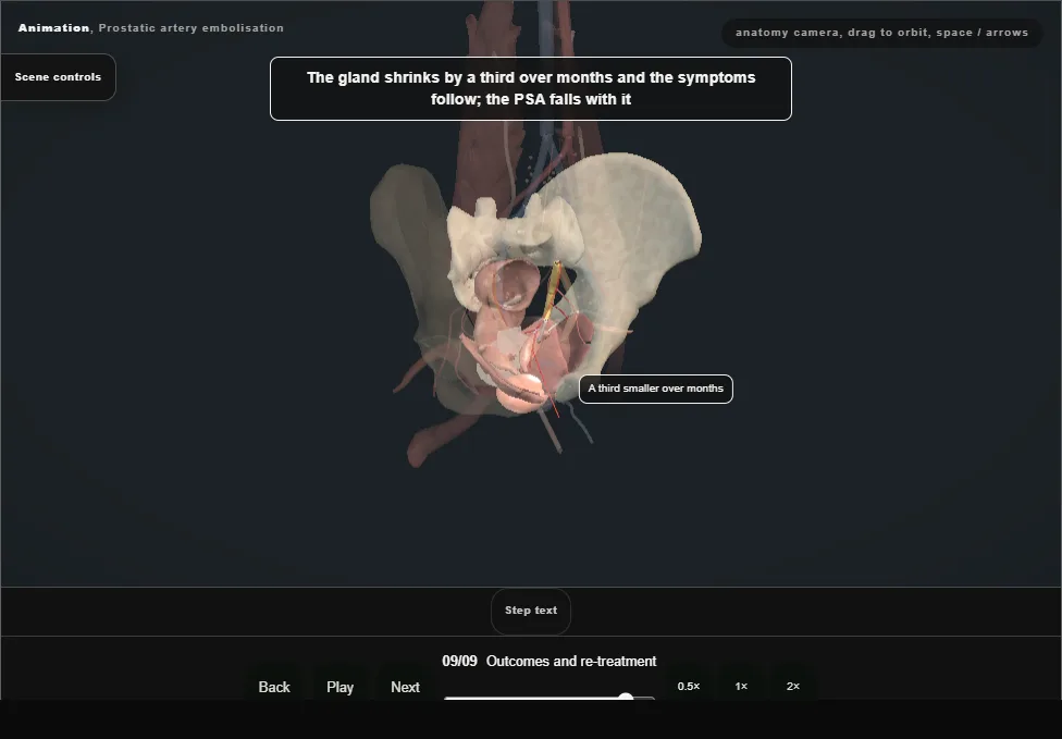 Prostatic artery embolisation. Step 9: Outcomes and re-treatment. Captured frame from the interactive animation.