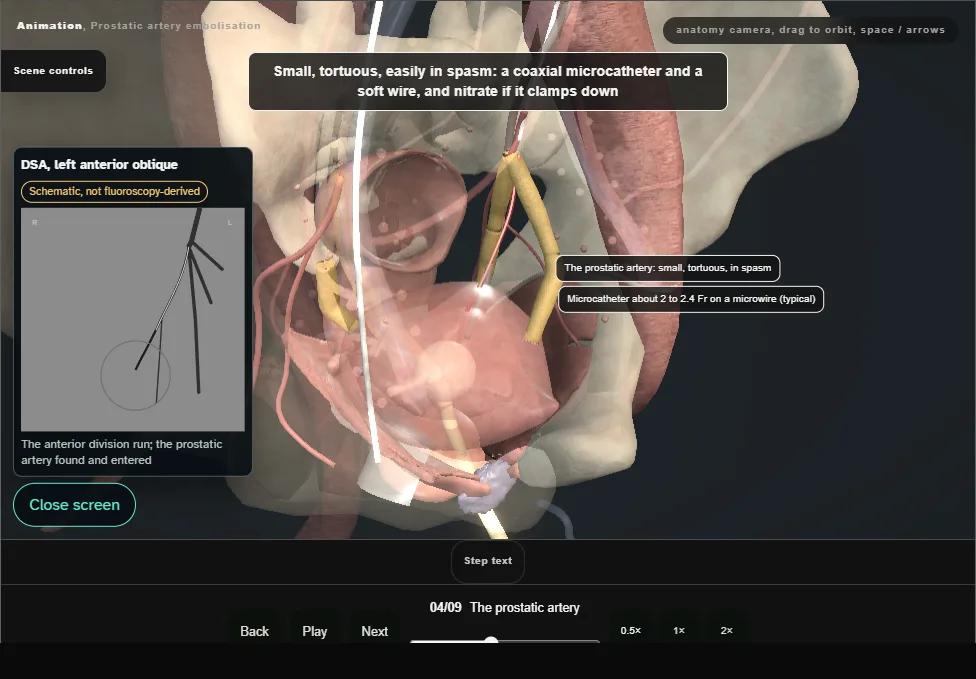 Prostatic artery embolisation. Step 4: The prostatic artery. Captured frame from the interactive animation.