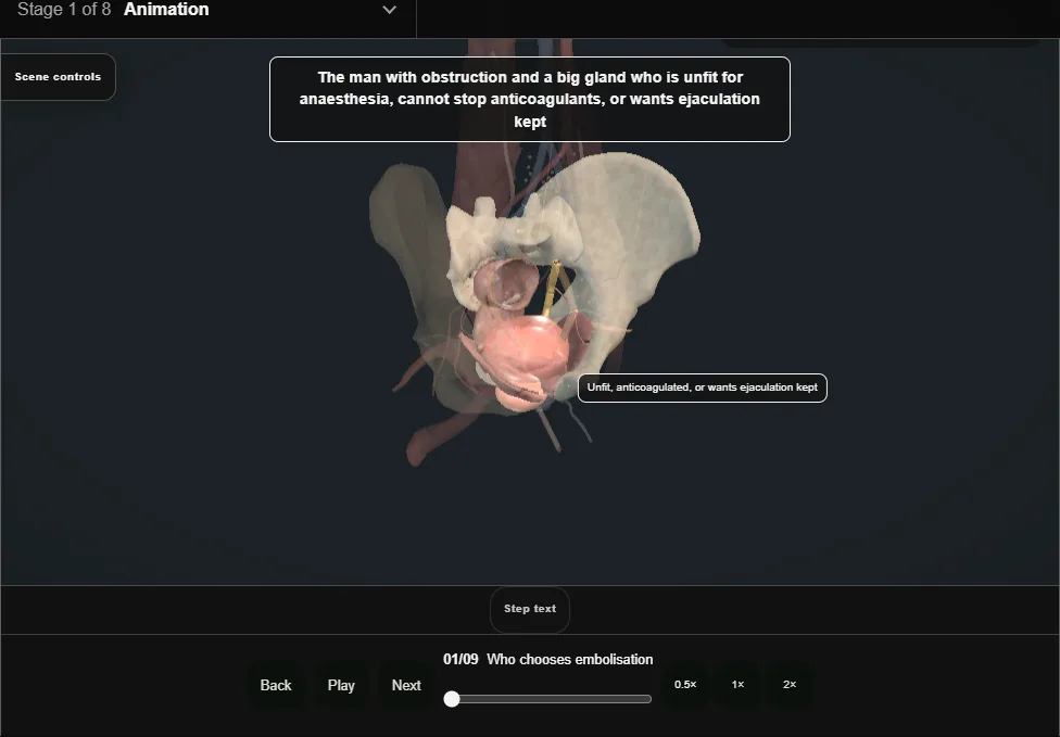 Prostatic artery embolisation. Step 1: Who chooses embolisation. Captured frame from the interactive animation.