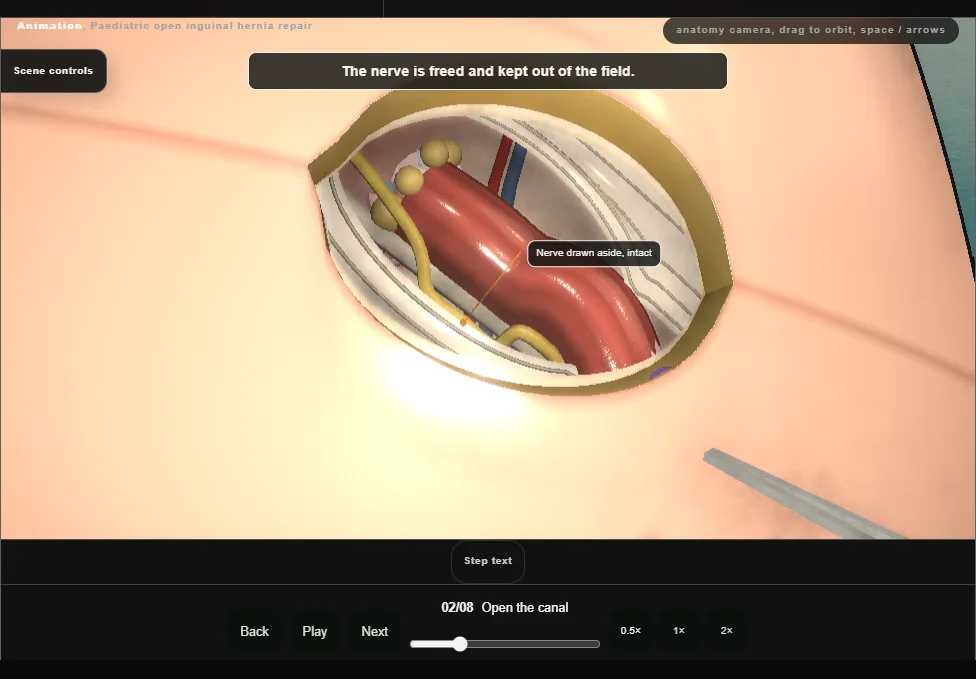 Paediatric open inguinal hernia repair. Step 2: Open the canal. Captured frame from the interactive animation.