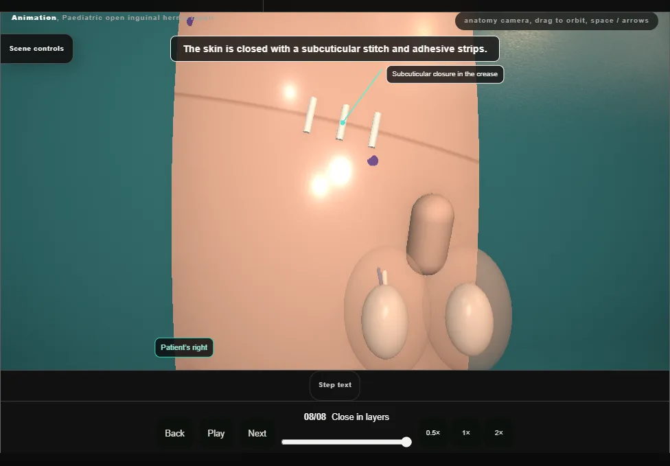 Paediatric open inguinal hernia repair. Step 8: Close in layers. Captured frame from the interactive animation.