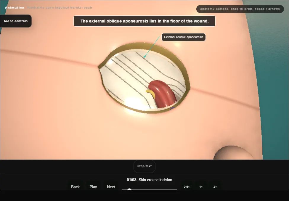 Paediatric open inguinal hernia repair. Step 1: Skin crease incision. Captured frame from the interactive animation.