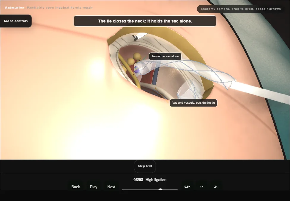 Paediatric open inguinal hernia repair. Step 6: High ligation. Captured frame from the interactive animation.